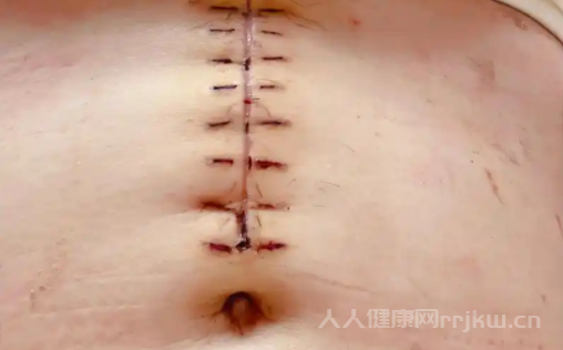 剖腹產一般需要多長時間手術