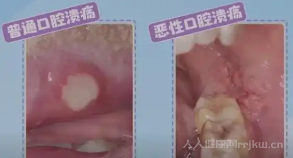 口底癌早期癥狀有哪些