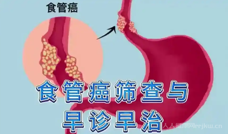 食管腫瘤能否治好