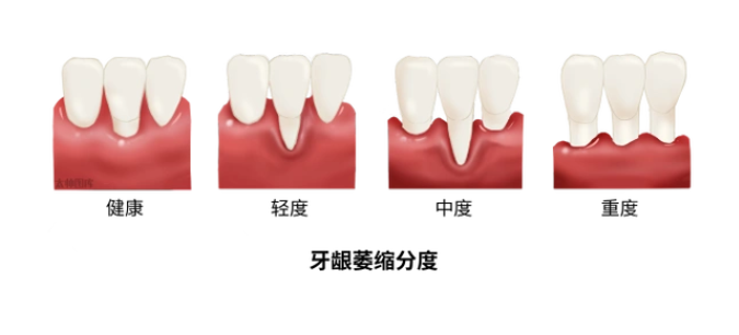 牙齦萎縮最快恢復方法是什么