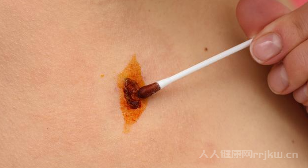 大人肚臍出血是癌癥嗎？