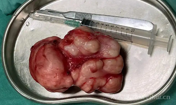 乳腺癌的復發率大概是多少？
