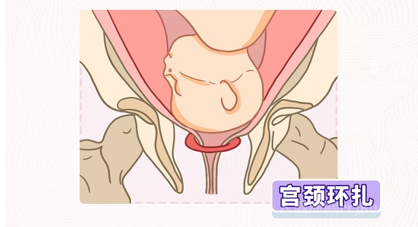 哪些人群不適合做宮頸環扎手術？