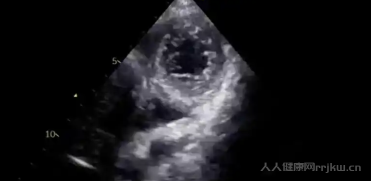 心肌致密化不全診斷標準是什么