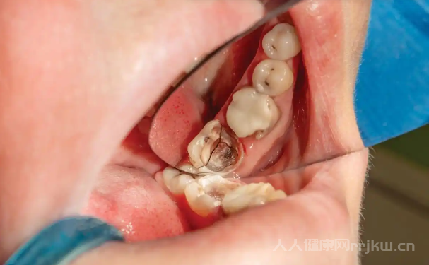 牙髓炎怎么治療