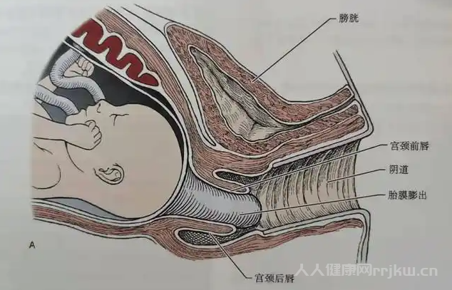 哪些孕婦不適合做宮頸環扎術？