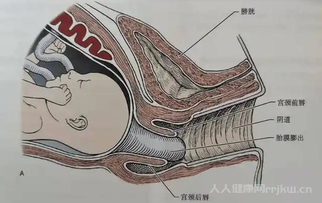 介紹一下宮頸環扎術的發展歷史