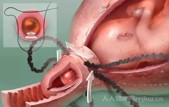 做宮頸環扎術的最佳時間是什么時候