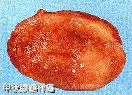 甲狀腺髓樣癌能活多久