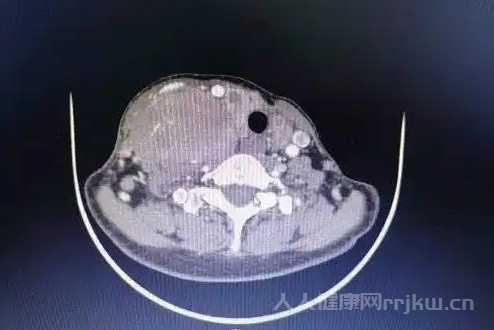 甲狀腺髓樣癌可以通過基因檢測來診斷嗎？