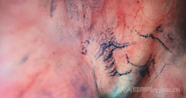 如何治療腸漏癥？