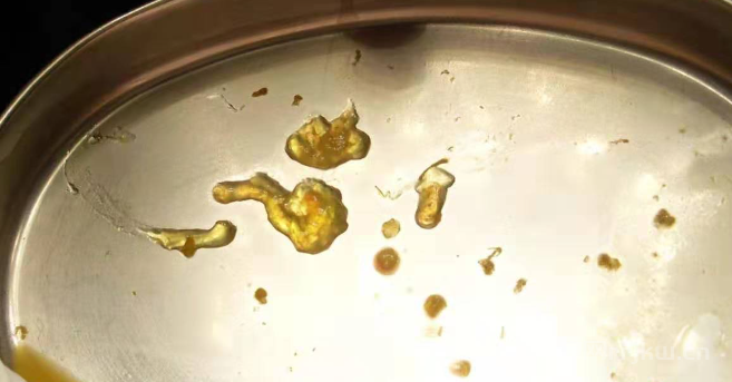 腸道菌群檢測對腸漏癥的診斷和治療有什么幫助？
