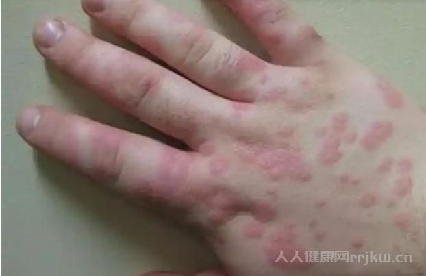 感染的癥狀是什么