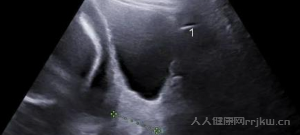 宮頸機能不全是什么原因導致的