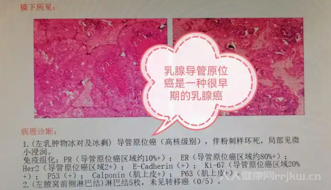 什么是乳腺導管癌,導致乳腺導管癌是什么原因圖1