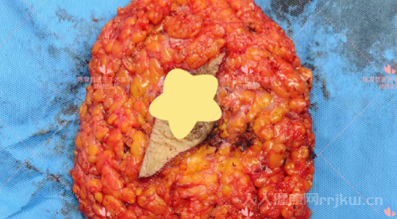 什么是乳腺導管癌,導致乳腺導管癌是什么原因圖2