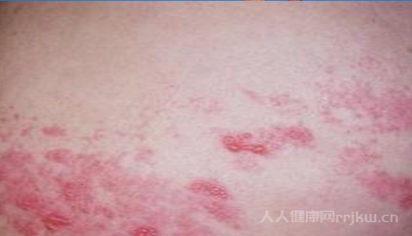 系統(tǒng)性紅斑狼瘡圖片,系統(tǒng)性紅斑狼瘡都有哪些癥狀？