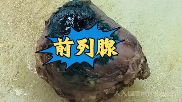 前列腺癌的典型早期癥狀需警惕的進展信號