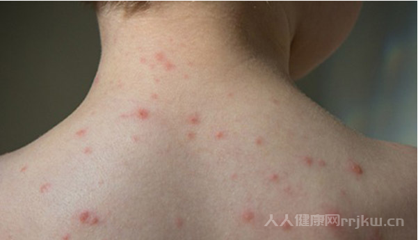 系統性紅斑狼瘡是什么病,系統性紅斑狼瘡早期癥狀有哪些圖1
