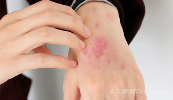 系統性紅斑狼瘡是什么病,系統性紅斑狼瘡早期癥狀有哪些圖3