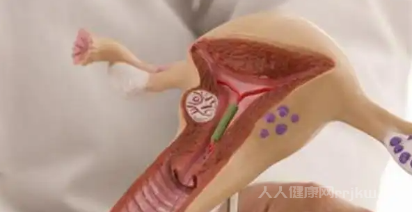輸卵管堵塞是什么原因造成的呢怎么治療